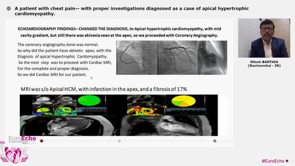 A patient with chest pain-- with proper investigations diagnosed as a case of apical hypertrophic cardiomyopathy.