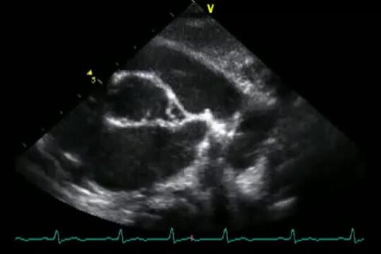 Echocardiography in Pediatric and Congenital Heart Disease 2e