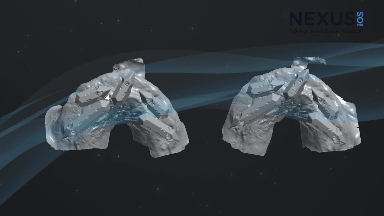 Keystone Dental Announces Market Launch of Nexus Connect, the First A.I.  Enabled Intraoral Implant-Scan Analyzer for the Nexus iOS Full-Arch  Solution