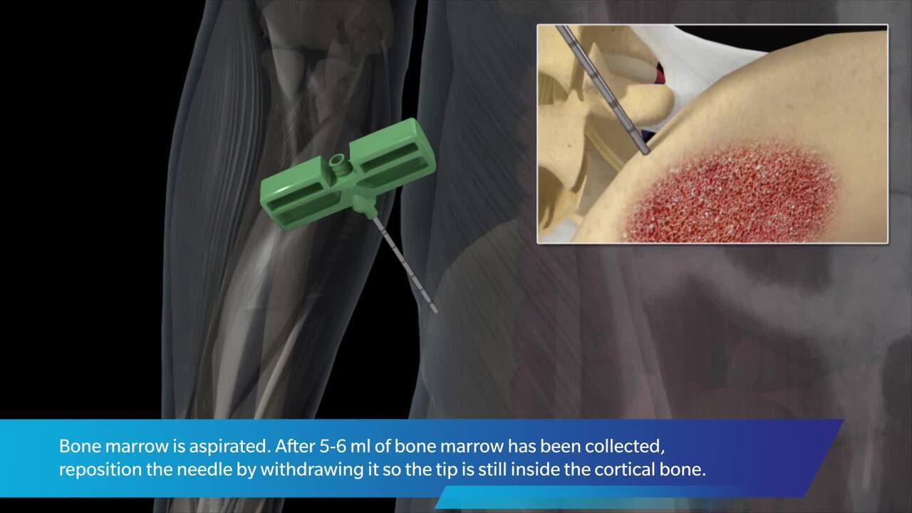 BioCUE® BBMA: Advanced Blood and Bone Marrow Aspirate
