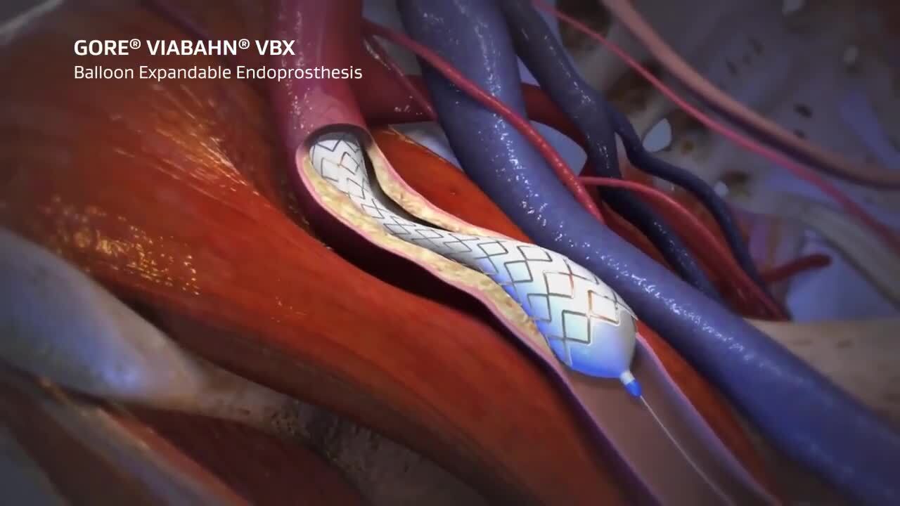 Animation of GORE&reg; VIABAHN&reg; VBX Balloon Expandable Endoprosthesis