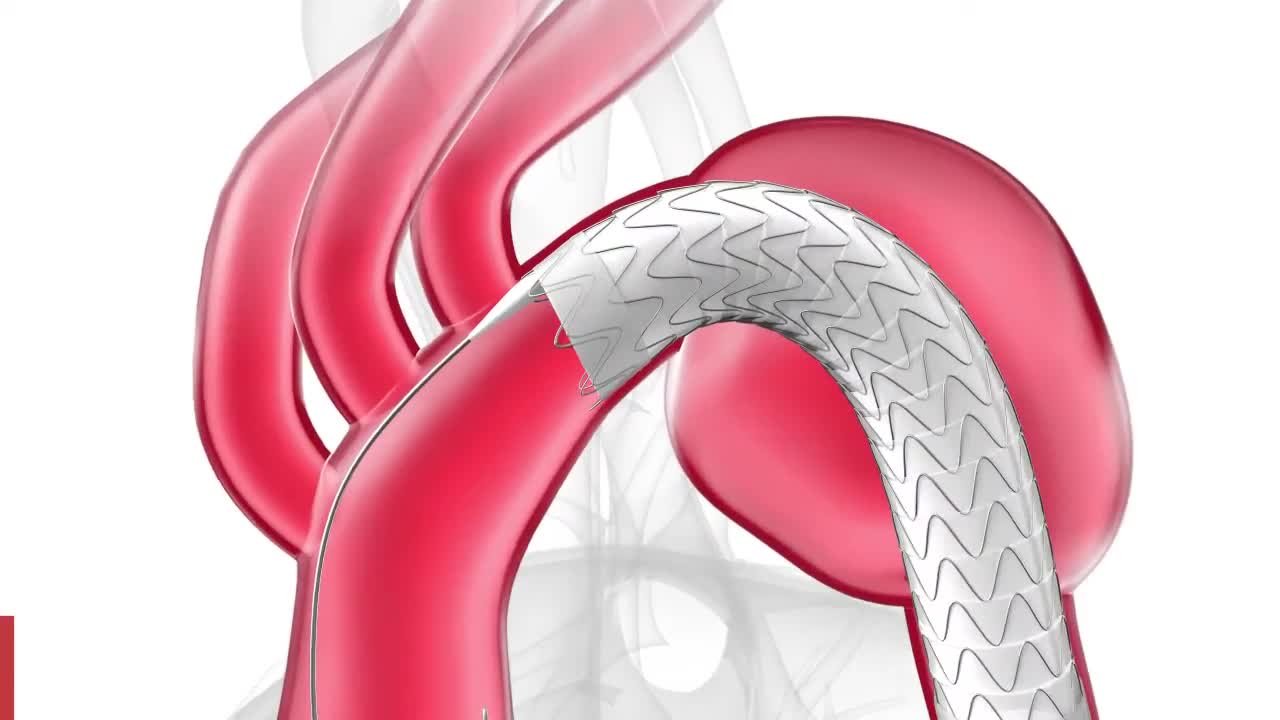 ゴア® TAG® コンフォーマブル 胸部大動脈ステントグラフト アクティブ 