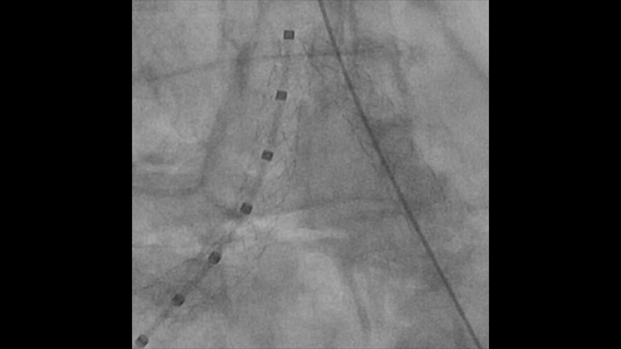 Animation of Kissing stents conformability