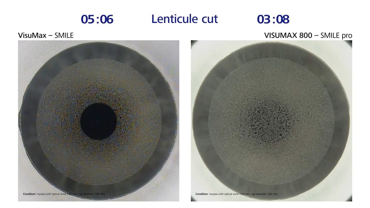 SMILE for myopia and myopic astigmatism – Increasing procedural ease and  efficiency with the VISUMAX 800 femtosecond laser | Ophthalmology Times  Europe, image size:1280x720