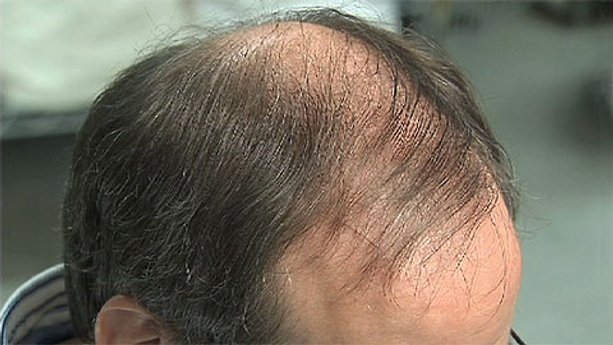 Coping with Hair Loss