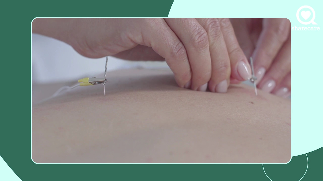 What Is electroacupuncture?