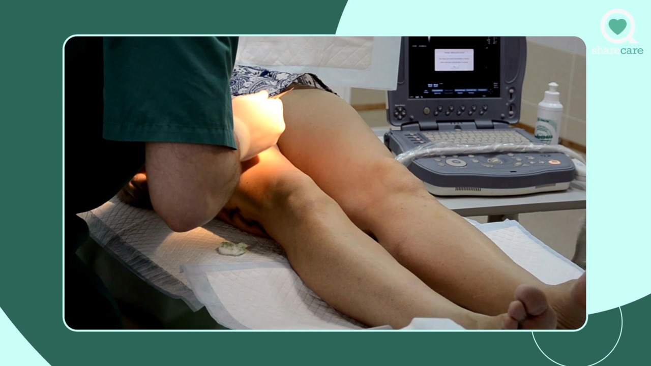 How is sclerotherapy performed?