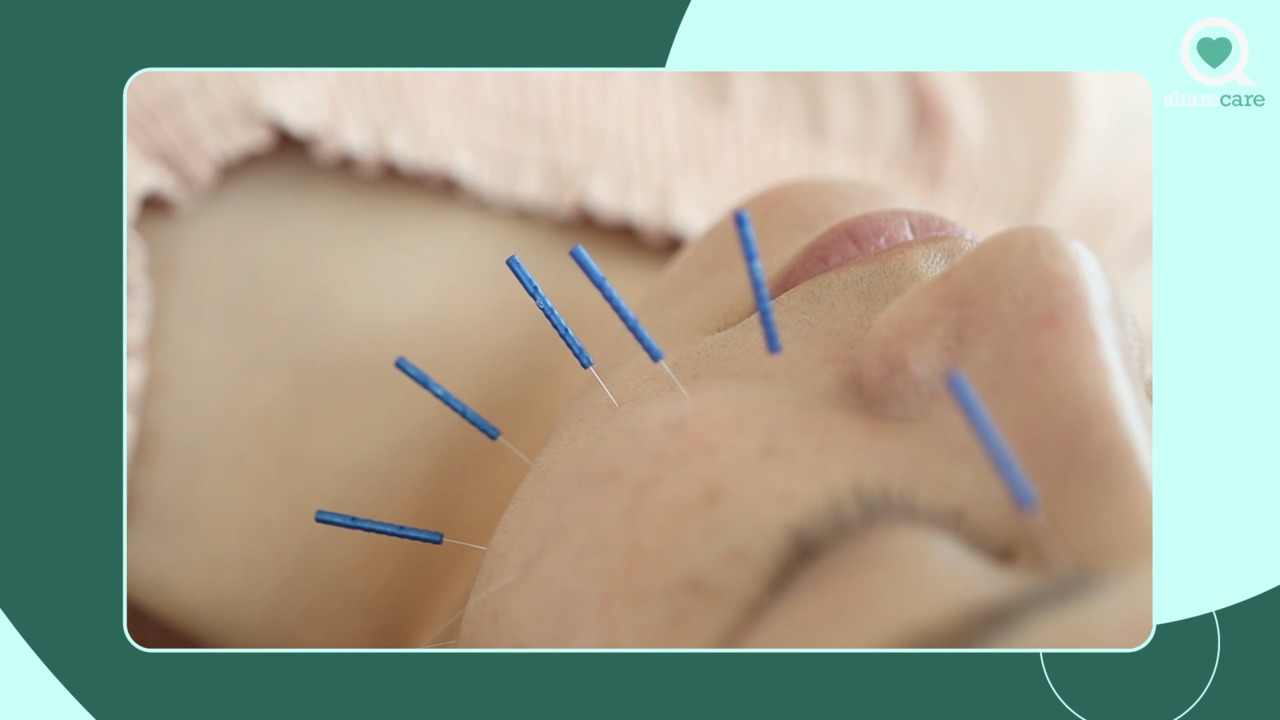 How do the results of an acupuncture face lift compare to surgery?