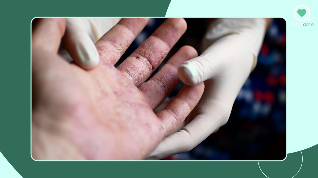 What do your psoriasis patients worry about with biologics?