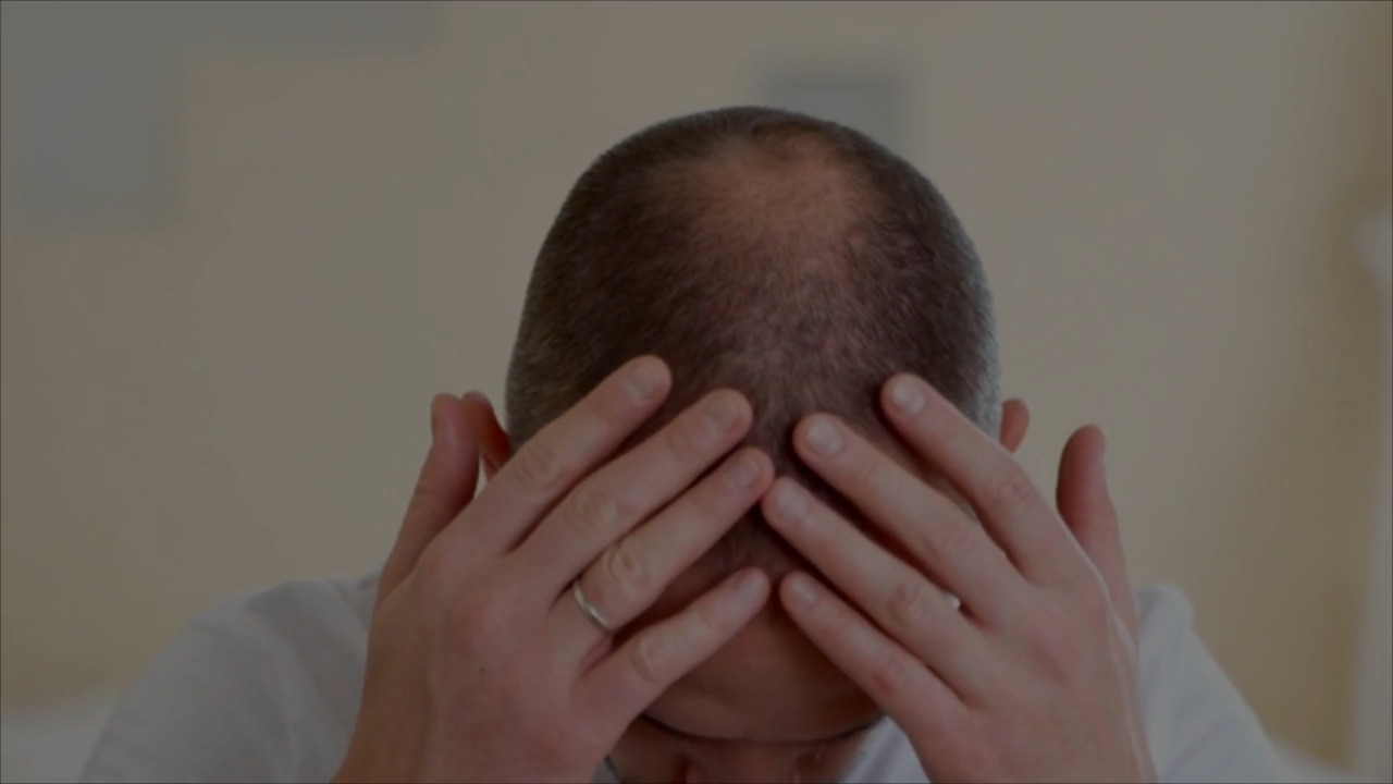 Minoxidil may be an inexpensive treatment for hair loss