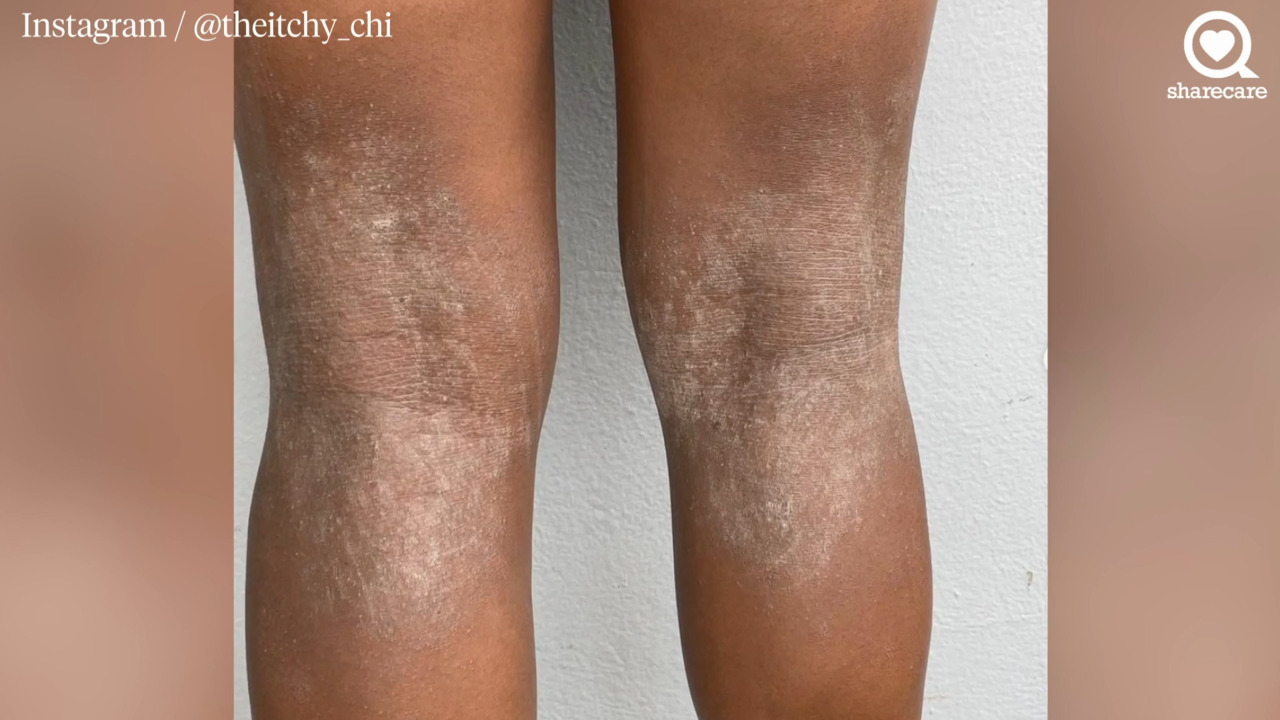 Life Unscripted: Why is trusting your dermatologist important when treating atopic dermatitis?