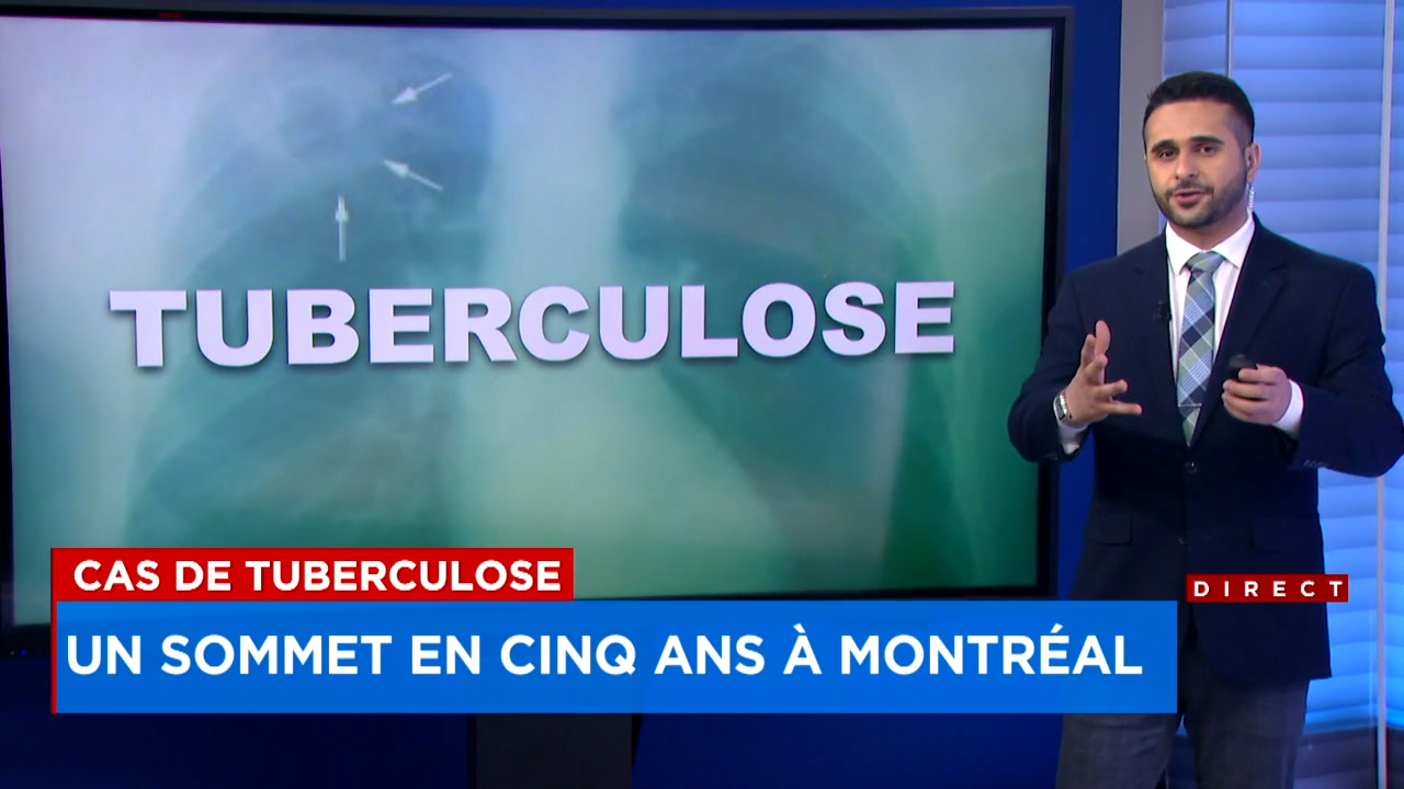 Sommet de cas en cinq ans: possible résurgence de la tuberculose à Montréal  | JDM