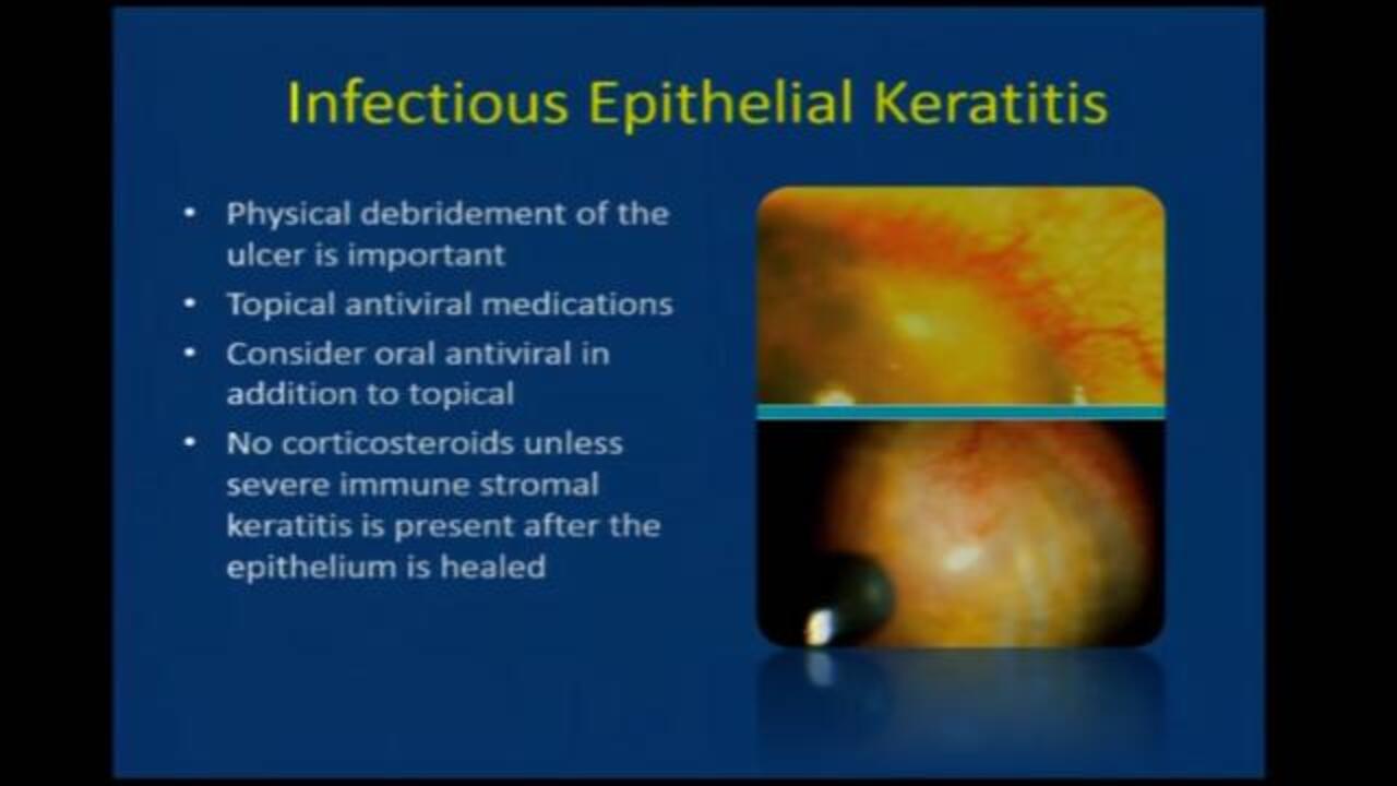 Video Update On Treatment Of Herpes Simplex Keratitis