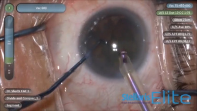 VIDEO: Surgeon shares cataract case with Stellaris Elite and enVista IOL