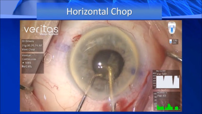 VIDEO: Surgeon discusses horizontal chop phaco technique