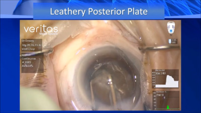 VIDEO: Phacoemulsification flip useful for dense nuclei