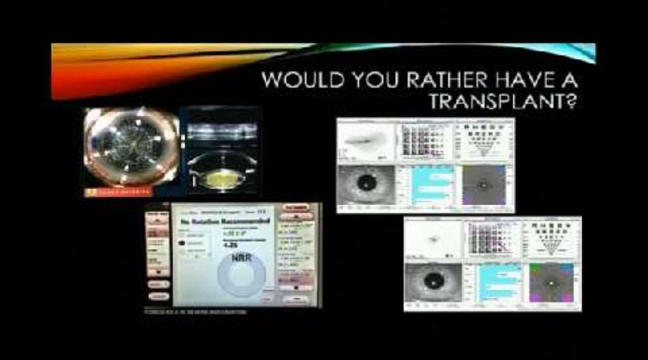 Cataract Surgery Video