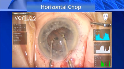VIDEO: Surgeon discusses phaco technique for dense cataracts