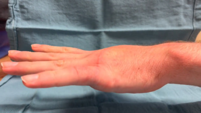 VIDEO: Final follow-up after metacarpophalangeal arthroplasty, metacarpal nonunion repair