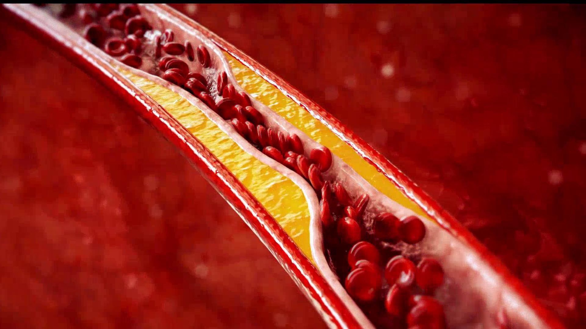 How watching your cholesterol can help prevent long term health problems
