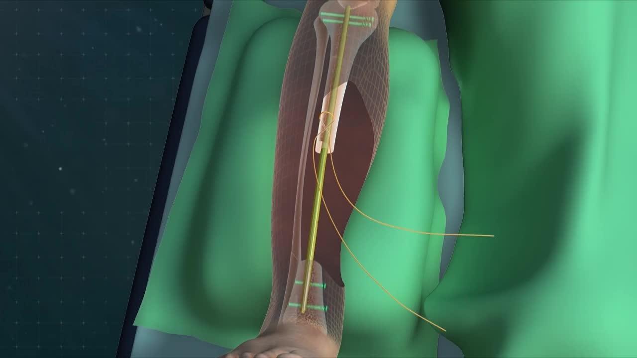 Double-level, proximal-to-distal bone transport using wire fixation. A