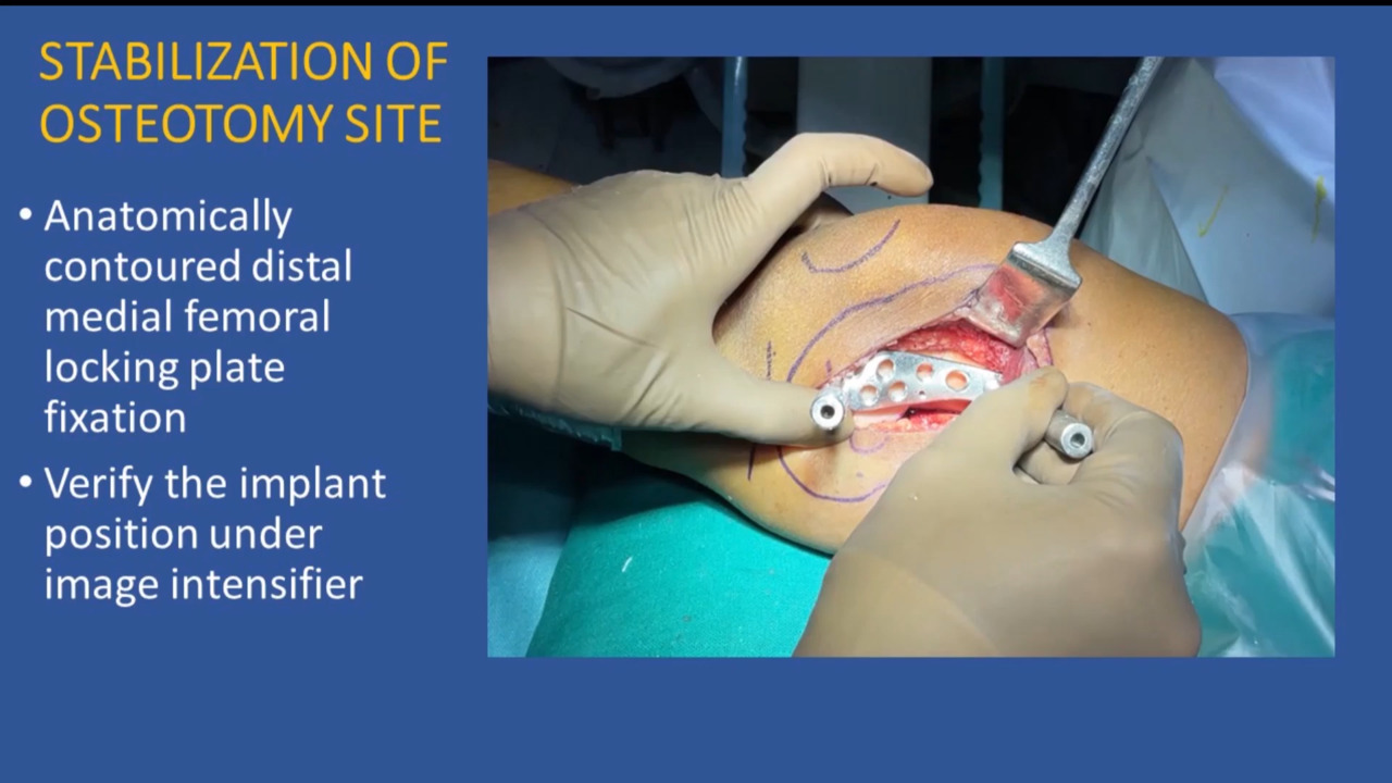 JBJS: Wedgeless V-Shaped Osteotomy of the Distal Medial