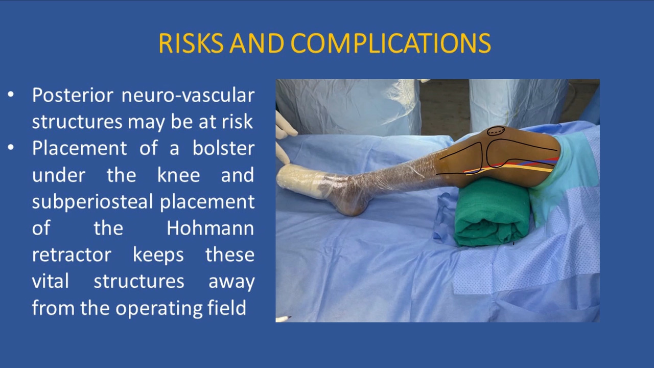 JBJS: Wedgeless V-Shaped Osteotomy of the Distal Medial