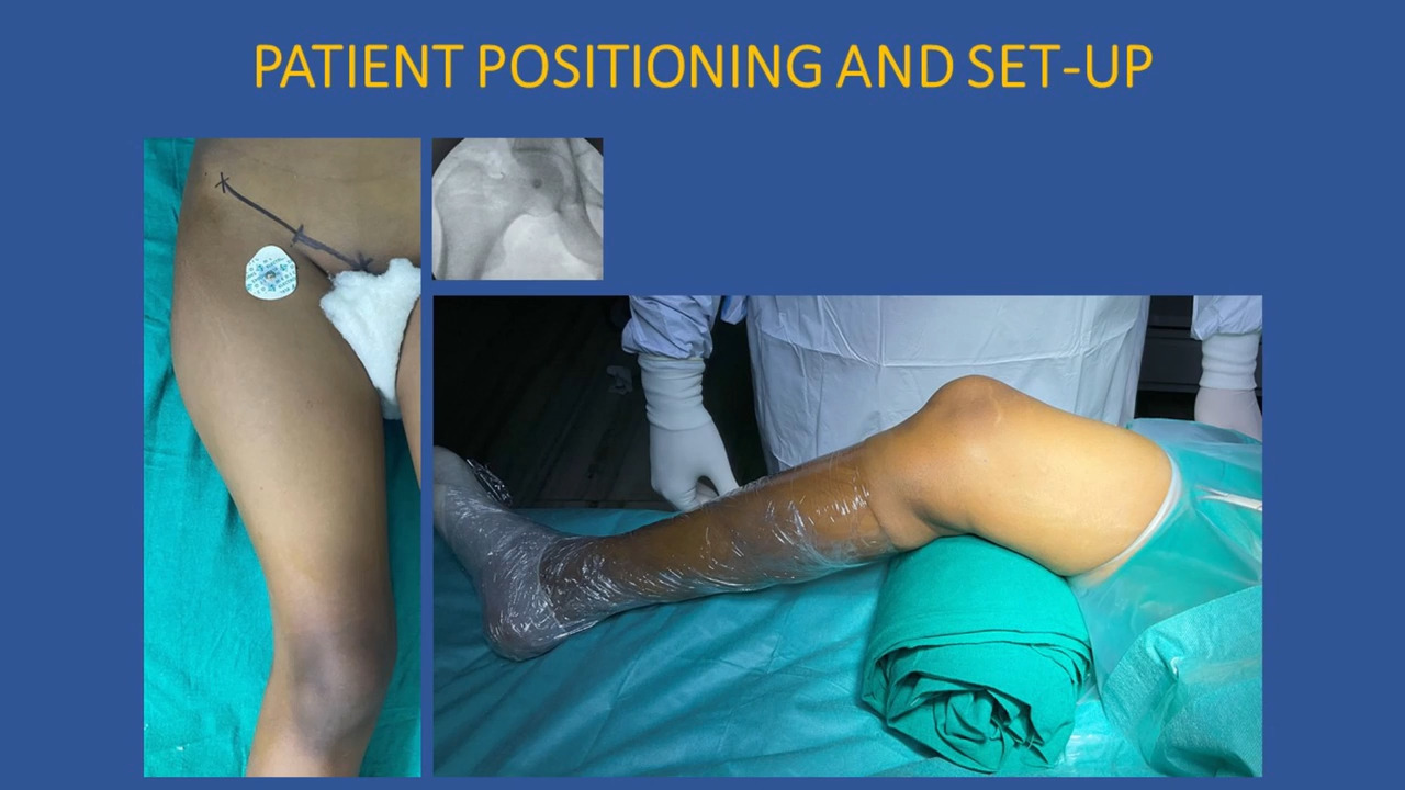 JBJS: Wedgeless V-Shaped Osteotomy of the Distal Medial
