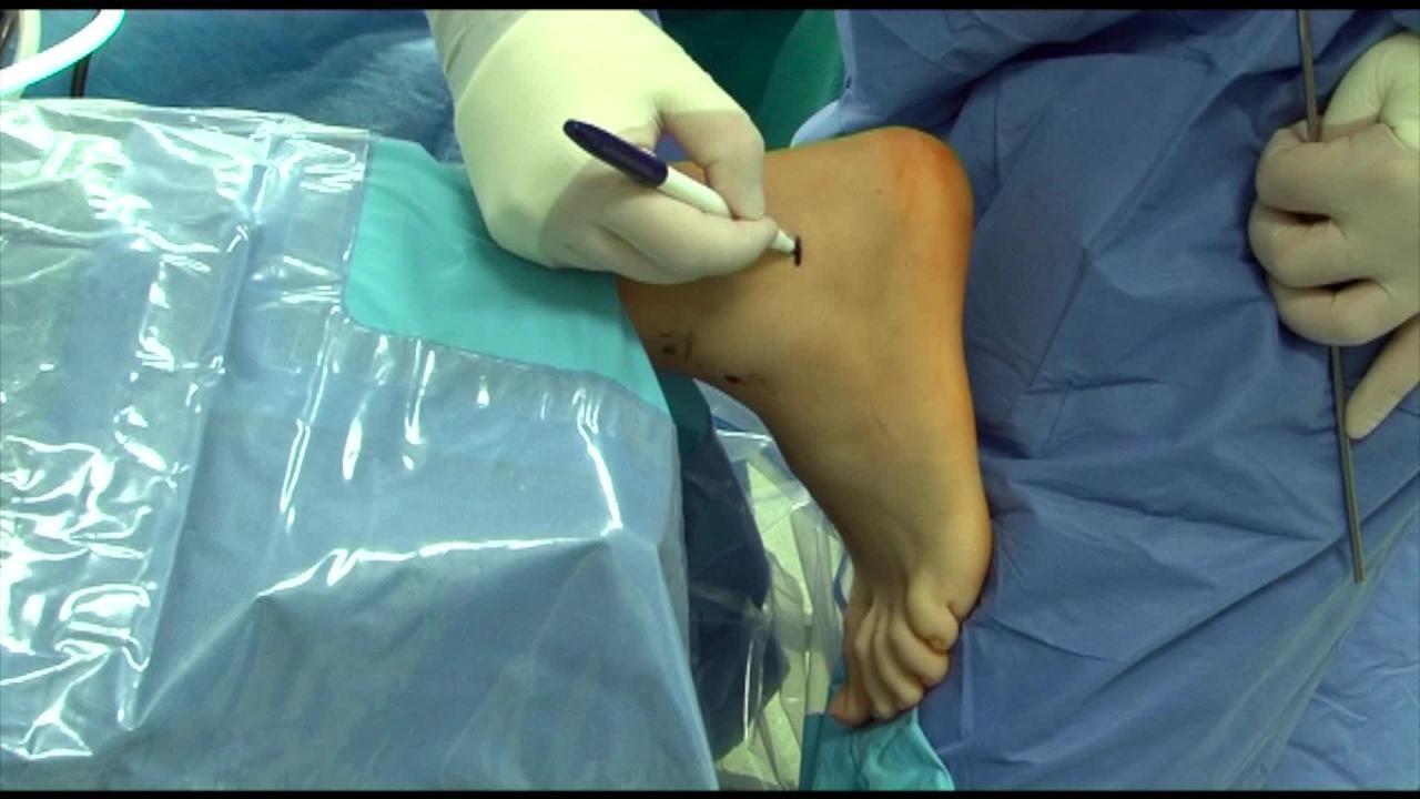 Ankle Arthroscopy: An Update : JBJS