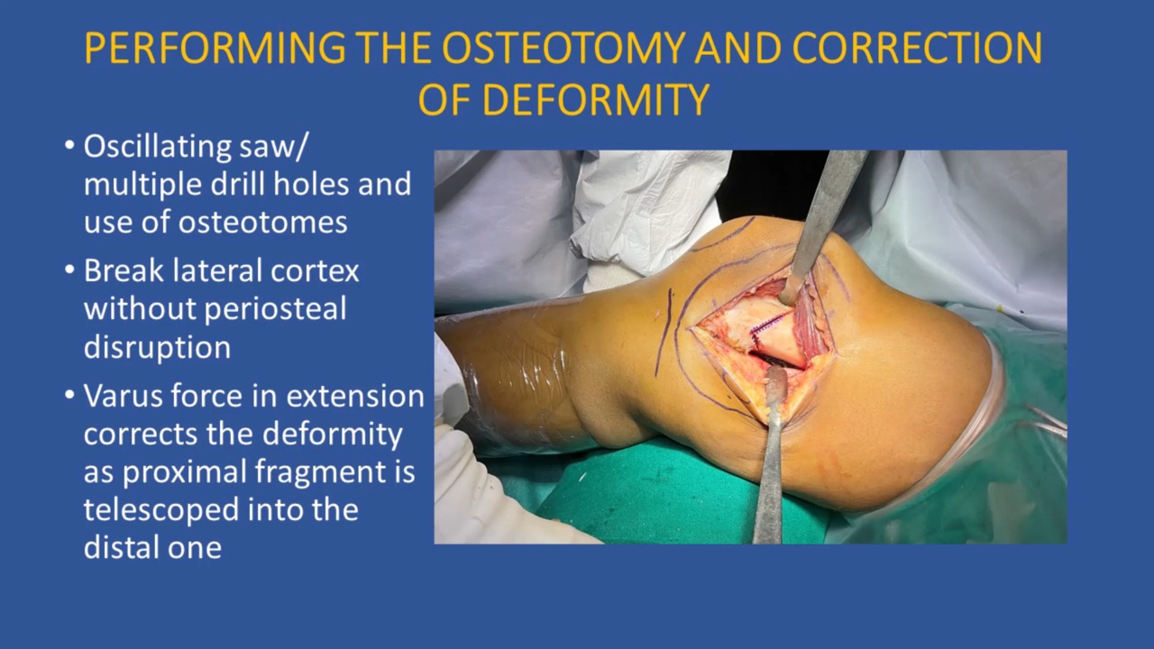 JBJS: Wedgeless V-Shaped Osteotomy of the Distal Medial