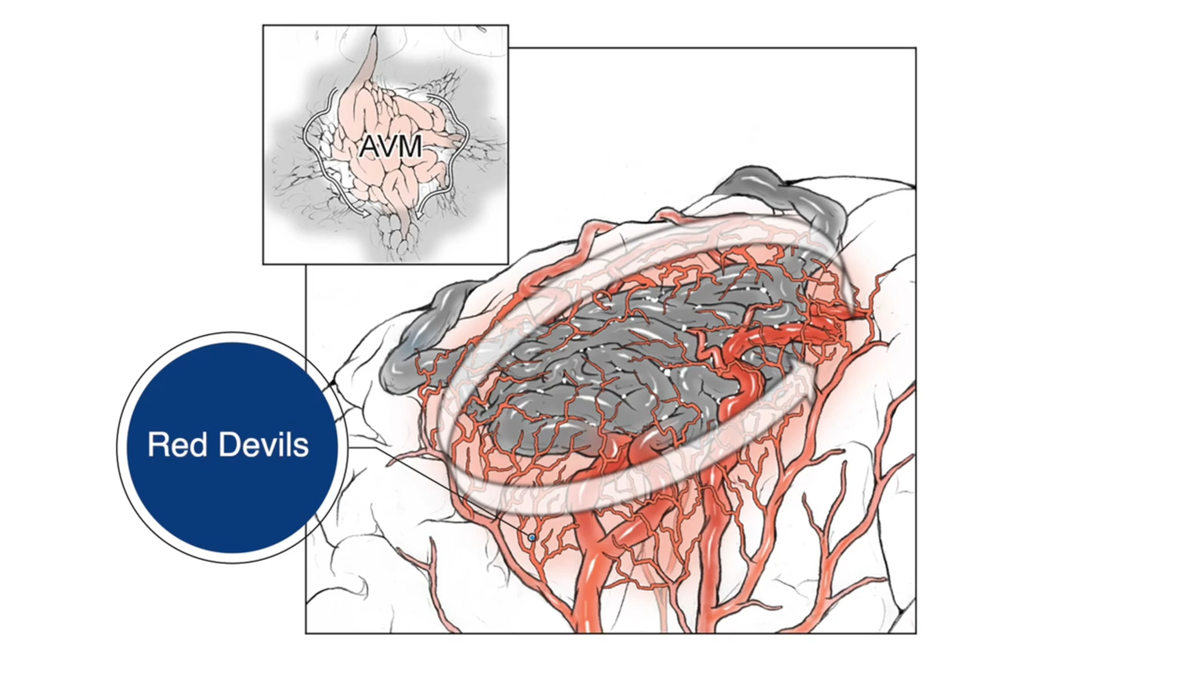 Episode 5: Slow - Spetzler Martin Grade IV AVM of the Temporal, Parietal, and Occipital Lobes