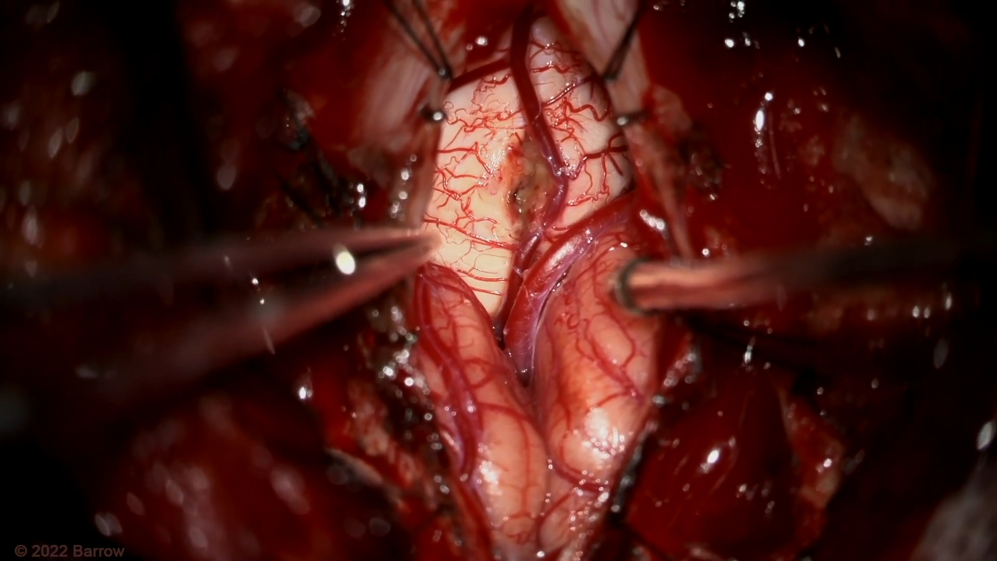 #168: Microsurgical Resection of an Inferior Medullary Cavernous Malformation