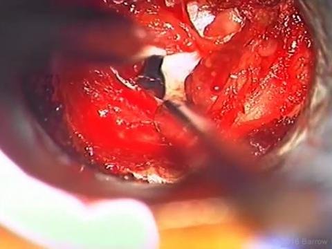 BQ_26-1_MIS foraminotomy_Video 3