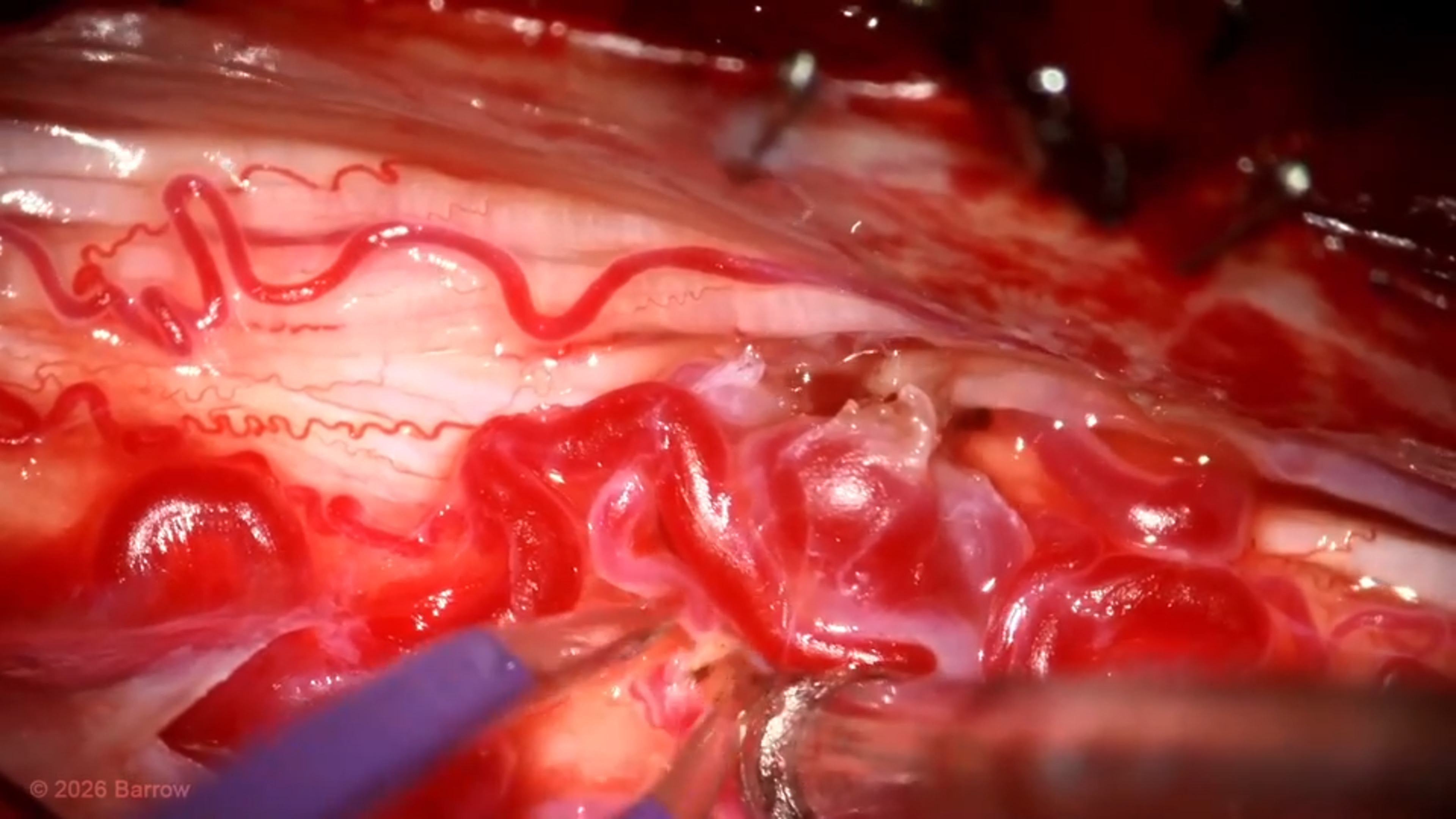 #547: Resection of a Thoracic Intramedullary Spinal Cord Arteriovenous Malformation (Concentric Type IV)