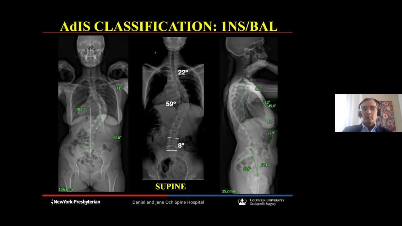 Adult Idiopathic Scoliosis (ADIS): A New Classification System and Treatment Recommendations