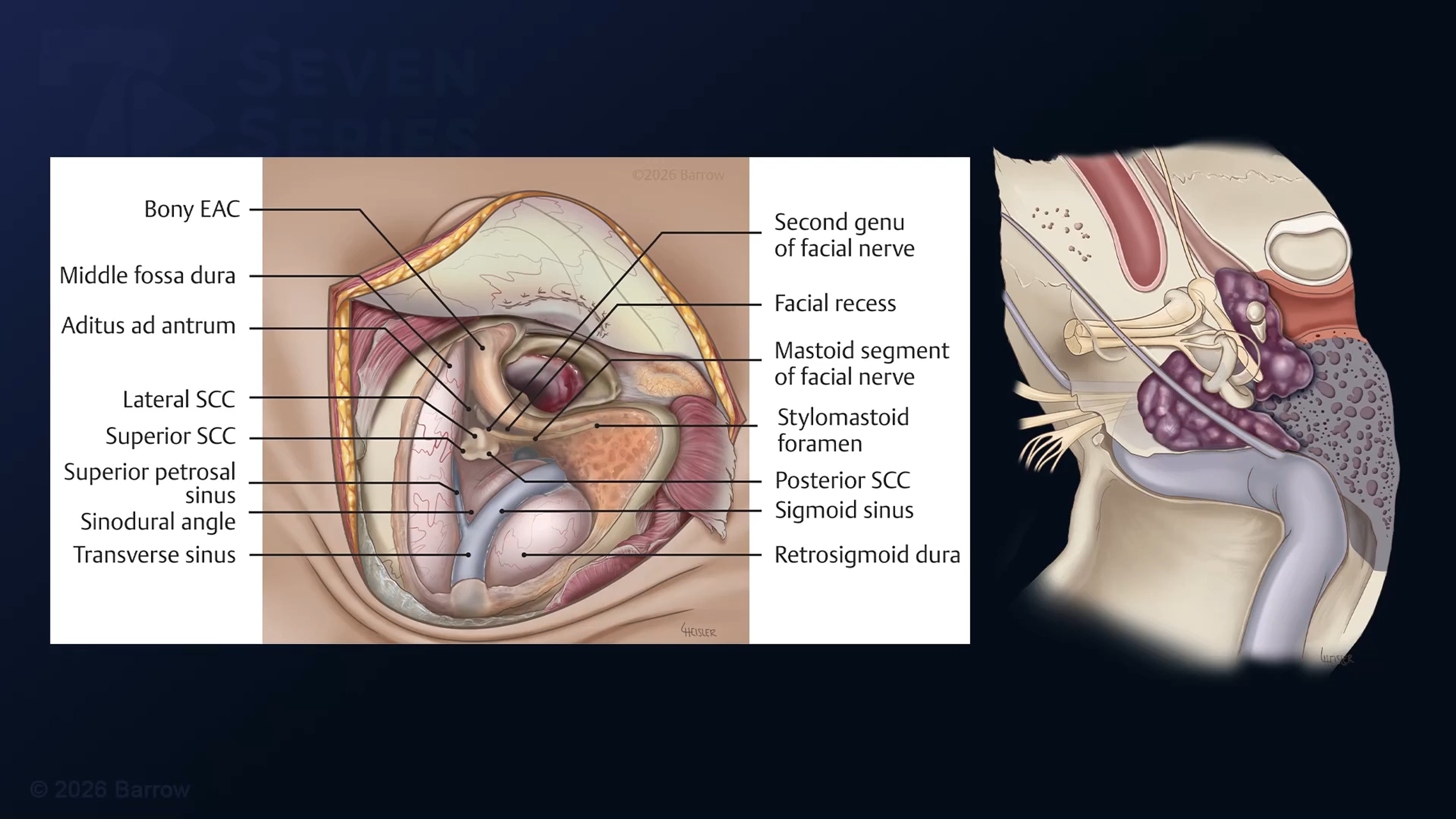 #557: Extended Transotic-Anterolateral Infralabyrinthine Transjugular Approach for Resection of Glomus Jugulare Tumor