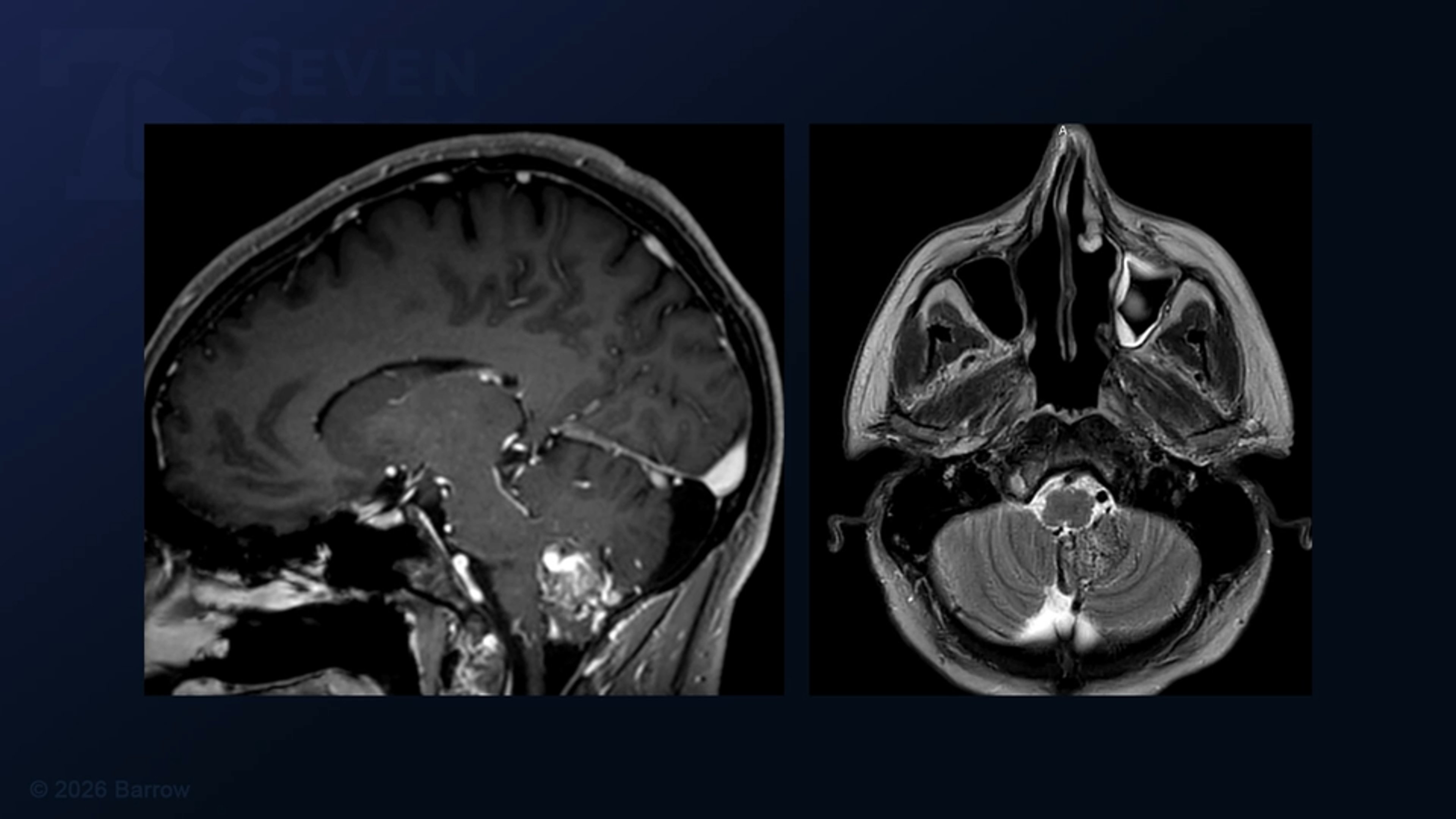 #558: Microsurgical Resection of a Tonsillar Cerebral Arteriovenous Malformation