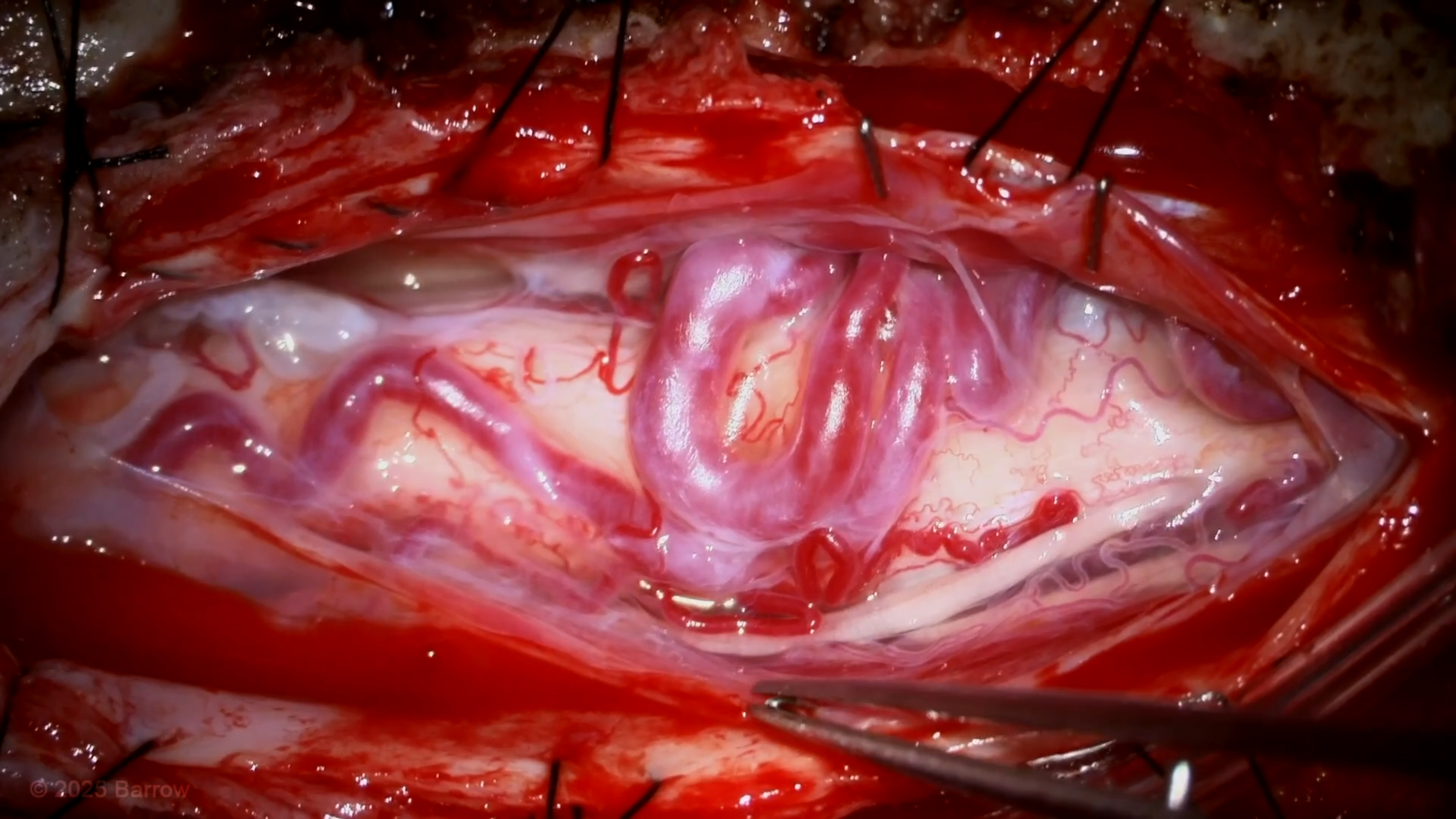 #427: Microsurgical Resection of a T9 Thoracic Intramedullary Spinal Cord Arteriovenous Malformation