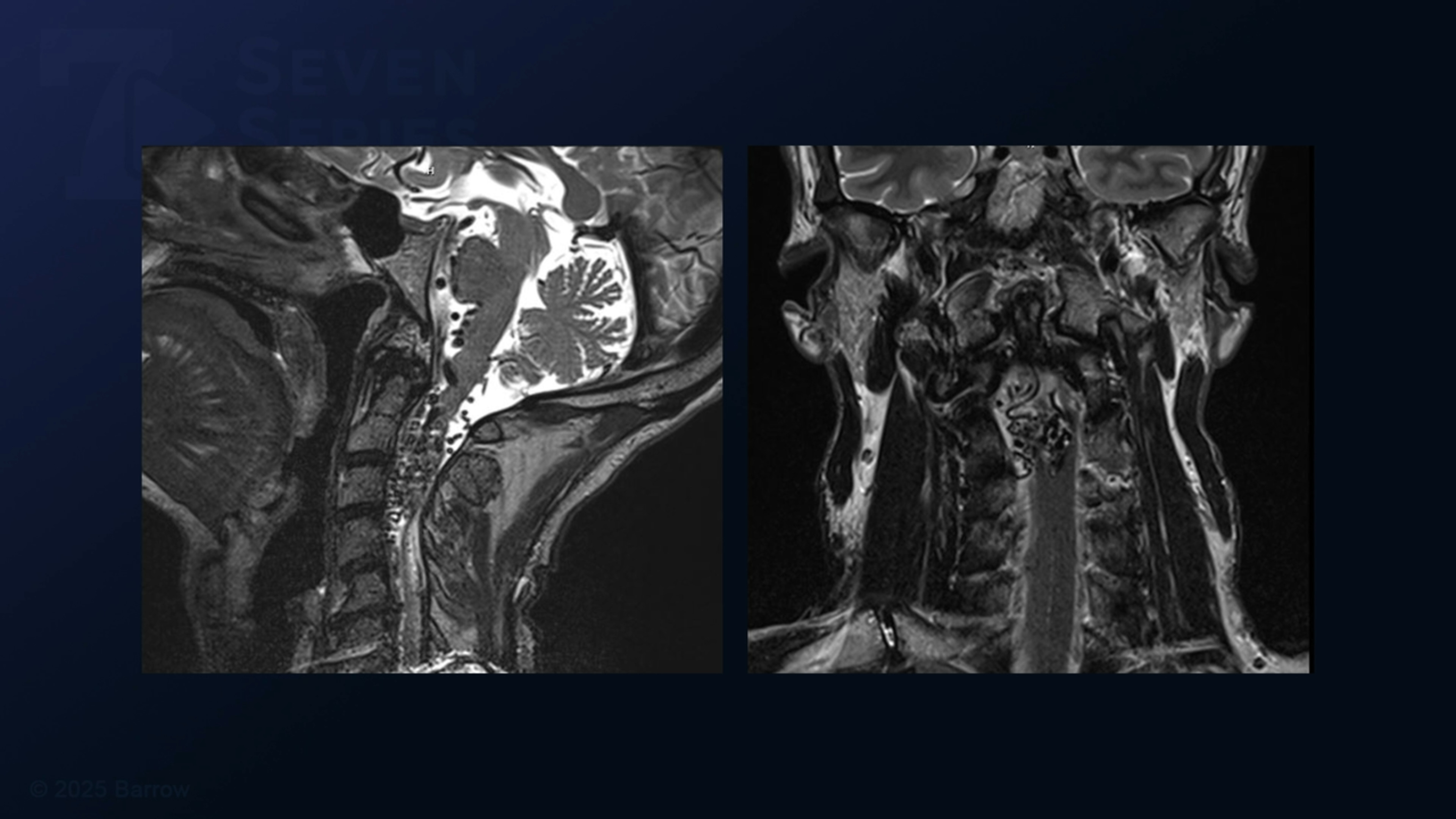 #435: In Situ Occlusion of a C1-C4 Intramedullary Spinal Cord Arteriovenous Malformation (Type II, Eccentric)