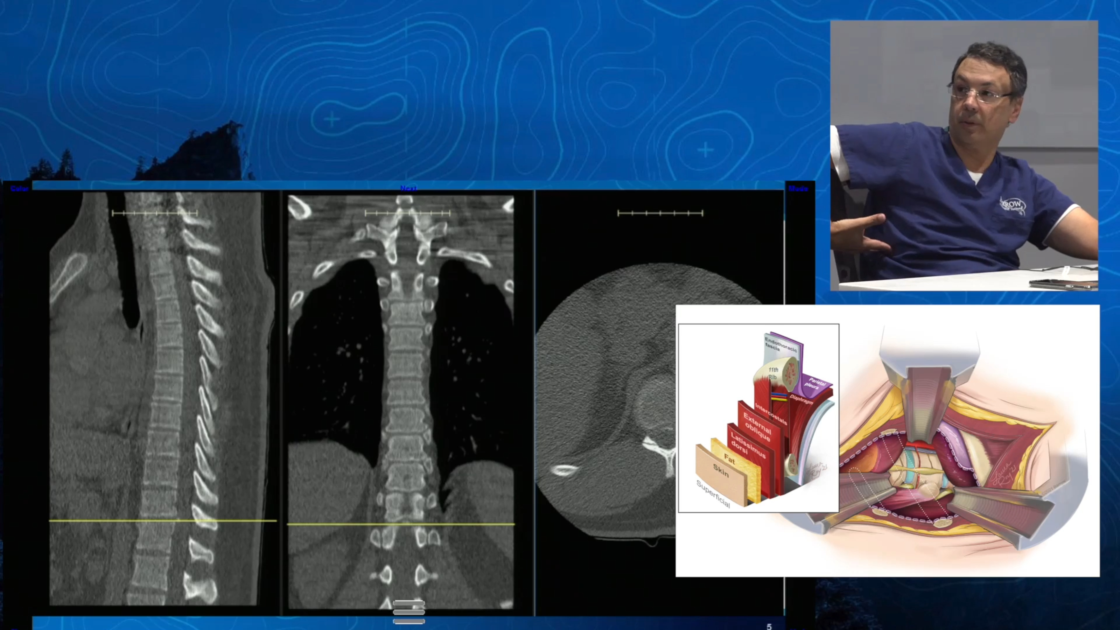 Episode 12: Calcified Thoracic Disc: The Most Complex Pathology for Spine Surgeons