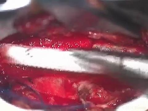 BQ_26-1_MIS intradural extramedullary_Video 2