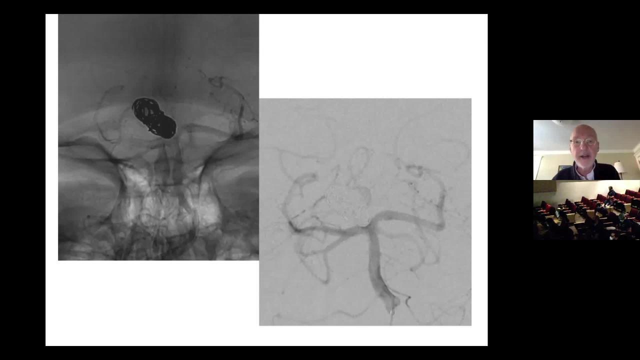 The Endovascular Management of Cerebral Aneurysms in the Era of Flow Diversion: Tales of Brave Ulysses