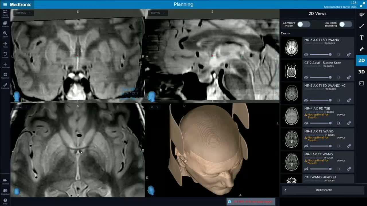 Asleep DBS Part 2: Incision Planning