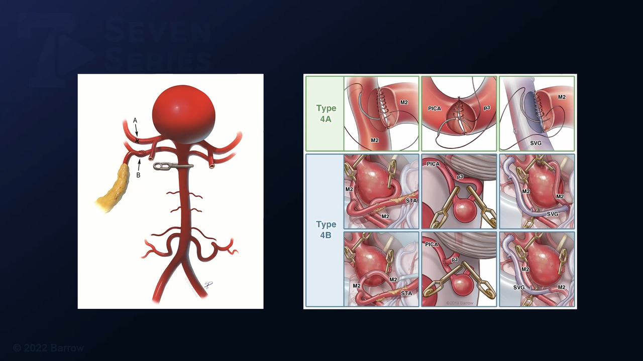 216 Common Carotid Artery To Internal Carotid Artery Interpositional