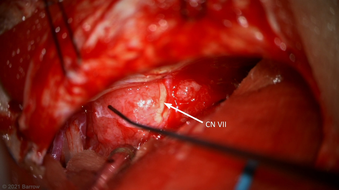 #51: Extended Retrosigmoid Craniotomy for Resection of a Medial Petrous Meningioma
