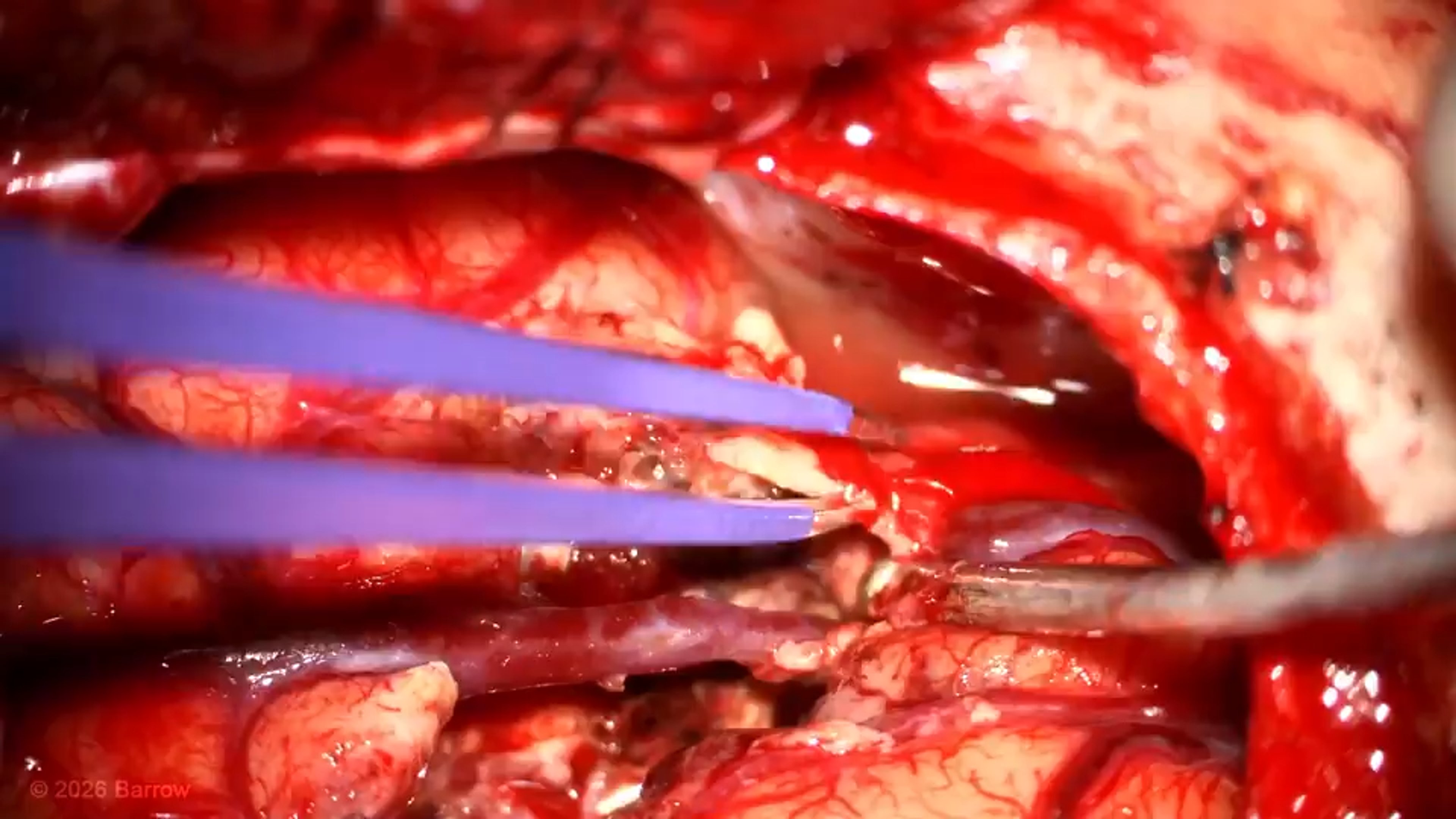 #553: Microsurgical Resection of a Temporal Horn and Basal Temporal Arteriovenous Malformation