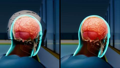 Animation: Helmet Versus No Helmet