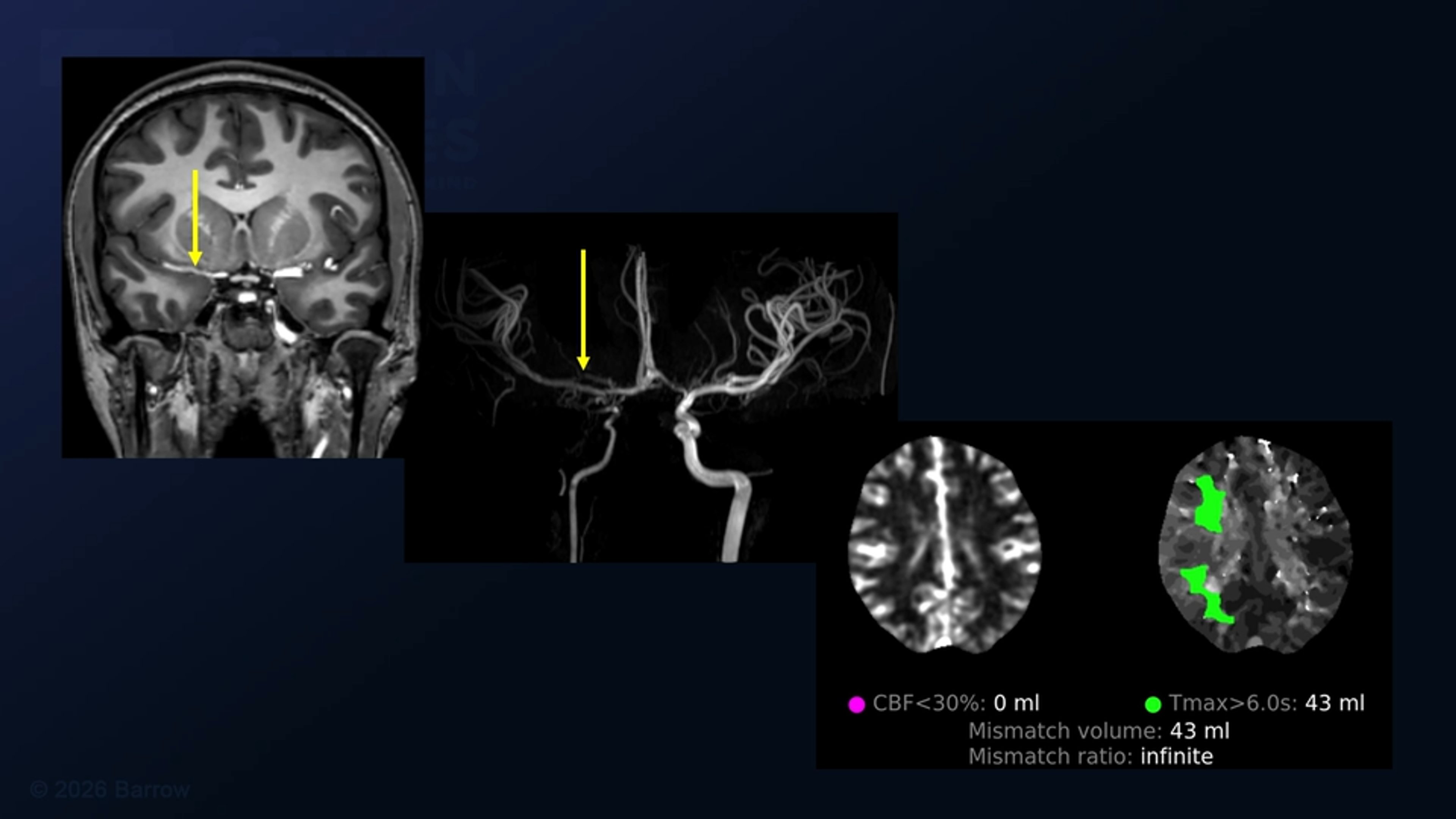 #564: How to Manage a "Through Stitch": Superficial Temporal Artery to M4 Middle Cerebral Artery Bypass for Moyamoya Disease