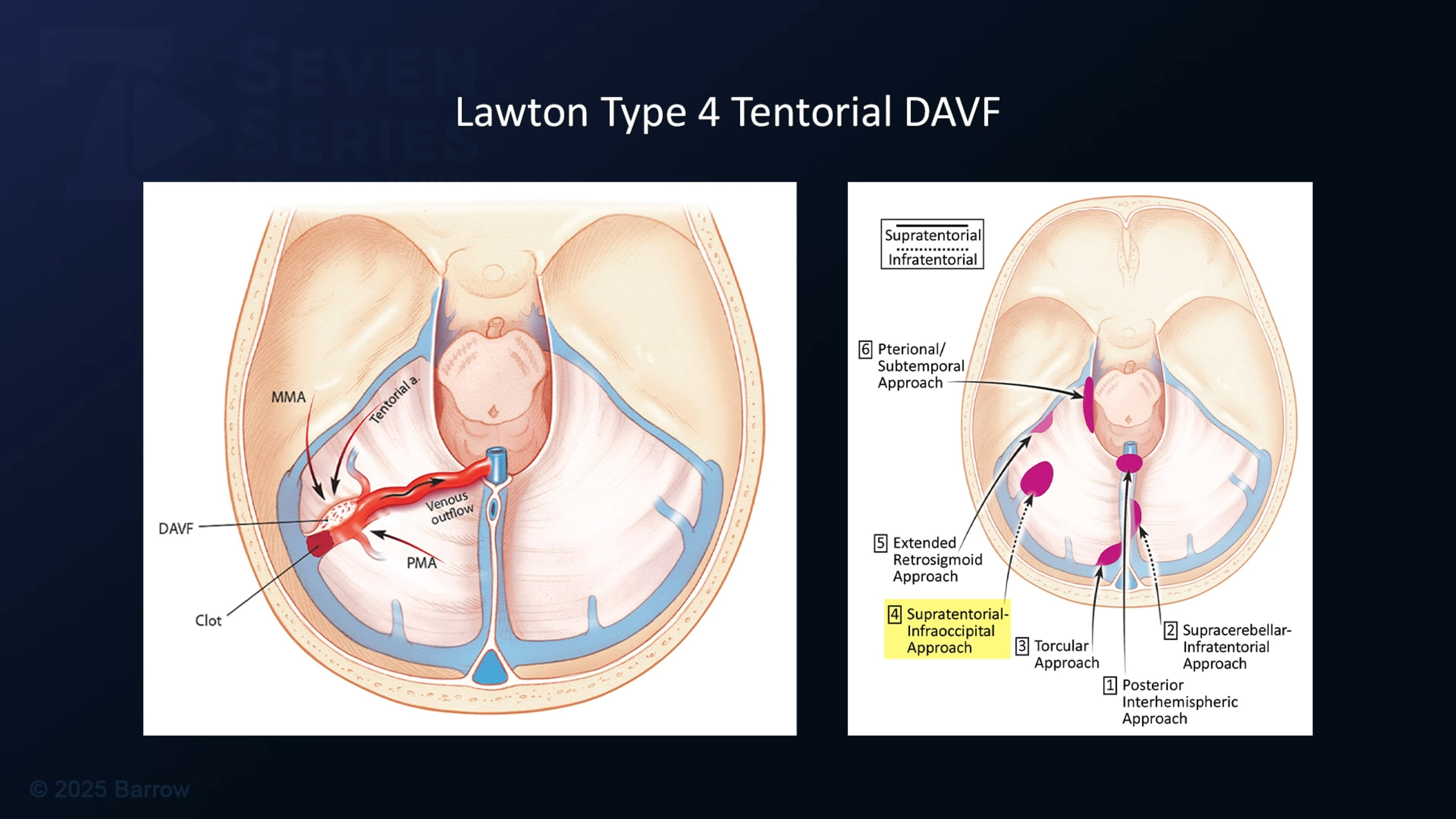 #422: Temporal Craniotomy for Occlusion of a Ruptured Tentorial Dural Arteriovenous Fistula (Type 4)
