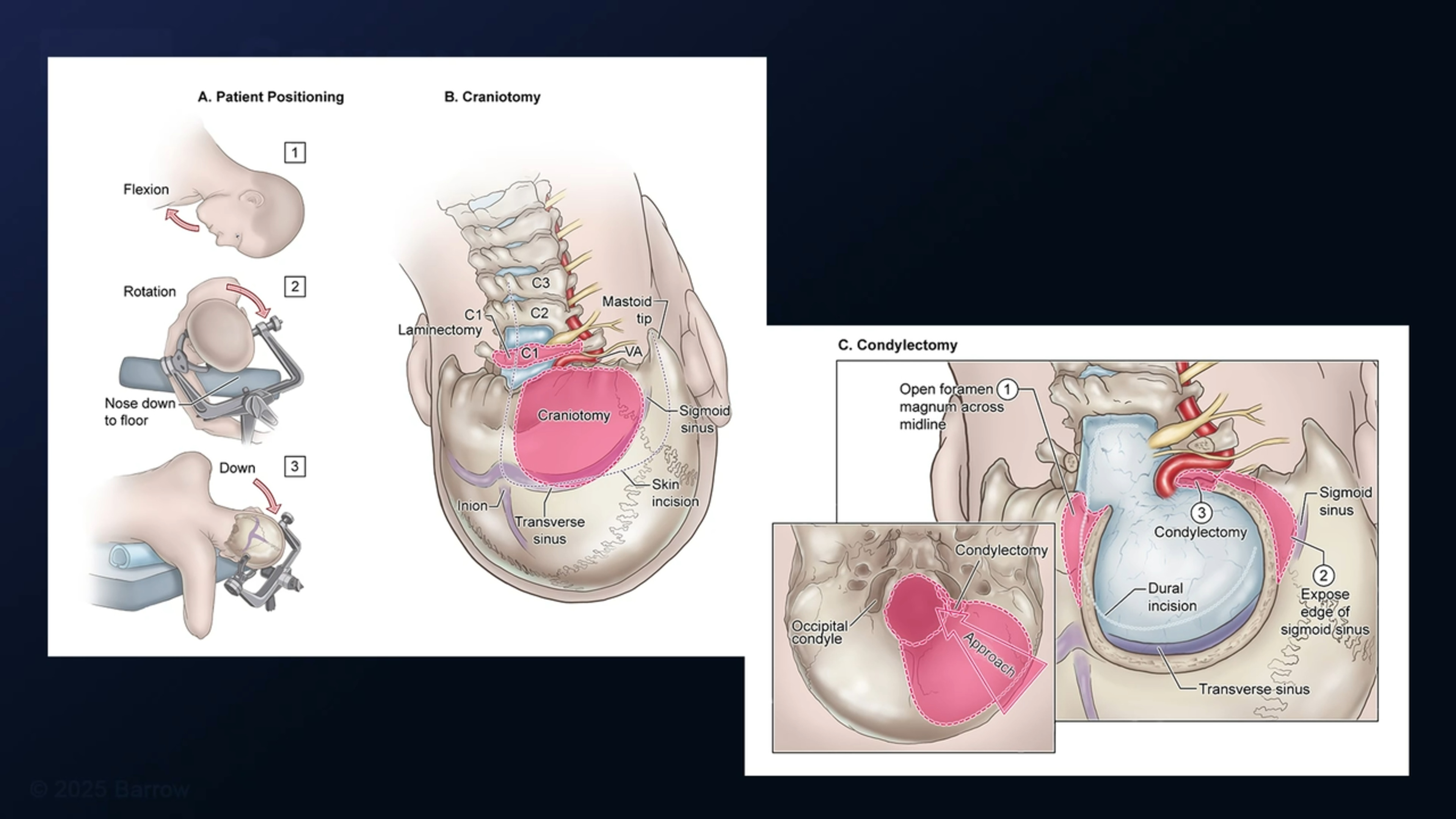 #397: Far Lateral Craniotomy for Resection of a Foramen Magnum Meningioma 